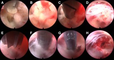 Percutaneous endoscopic interlaminar discectomy for L5-S1 calcified lumbar disc herniation: A retrospective study